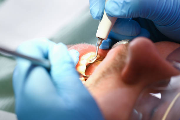 Best Emergency Gum Treatment in Union Hill Novelty Hill, WA